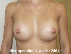 plastic-surgery-breast-augmentation 